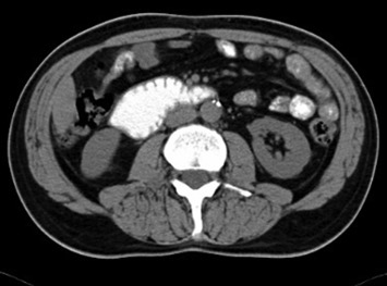 Multislice computed tomography demonstrates a filling defect in the fourth part ...