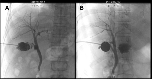 Contrast medium is infused via the gallbladder drainage catheter and shows flow ...