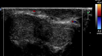 Eco‐Doppler peniano transversal. Ausência de fluxo VS.
