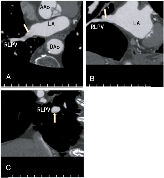 A: Axial images vaguely showing an apparently small thrombus in the right lower ...