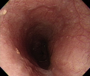 EGD revealed two tiny yellowish plaques in the lower esophagus. It presented as ...