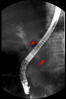 Endoscopic retrograde cholangiopancreatography – the obstruction (arrow) and ...