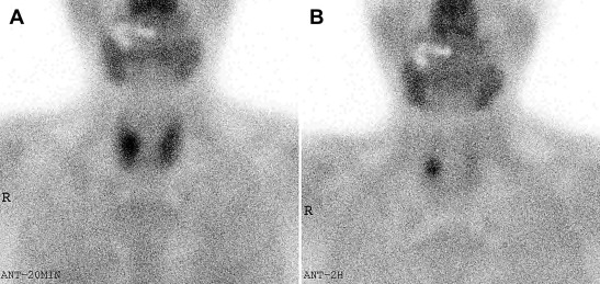 MIBI scintigraphy. (A) MIBI uptake in both thyroid areas 20 minutes after MIBI ...