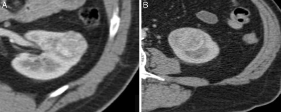 À esquerda, temos um oncocitoma. À direita, um CCR‐cc. Não existem diferenças ...