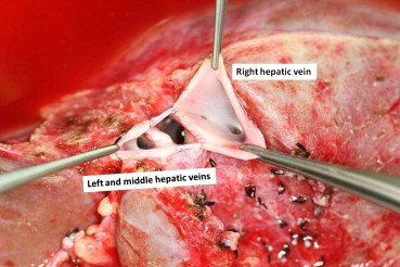 Venoplasty of the amyloidotic hepatic allograft right hepatic vein and middle ...