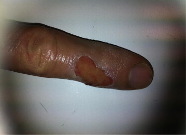 Finger of the surgeon on Day 1 following a burn from the intra-abdominal ...