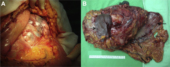 (A) The tumor was seen beneath the colon and omentum when the abdominal cavity ...
