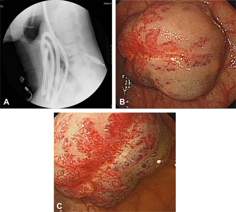 (A) Fluoroscopy of the endoscope at the end of insertion suggests a target ...