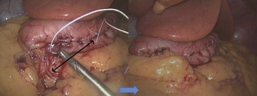 Fixation of gastric tube to retroperitoneum.