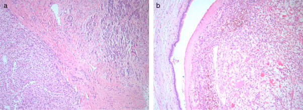 (a) Intrapancreatic metastasis from renal cell carcinoma; (b) Endoluminal growth ...