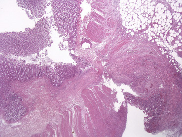 Pathology report shows acute diverticulitis with perforation.