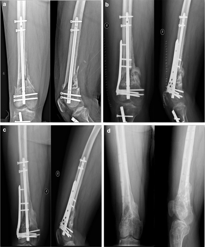 a Distal femoral nonunion after retrograde intramedullary nail of type AO33C2 ;b ...
