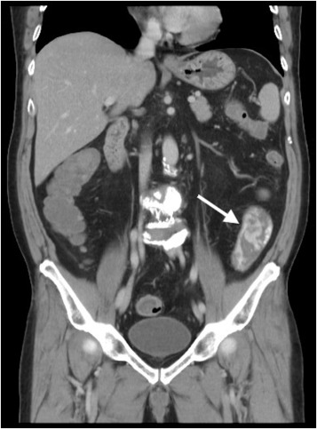 Abdominal computed tomography span revealed active contrast extravasation from ...