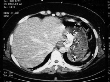 Computed tomographic scan of the abdomen with intravenous contrast showing the ...