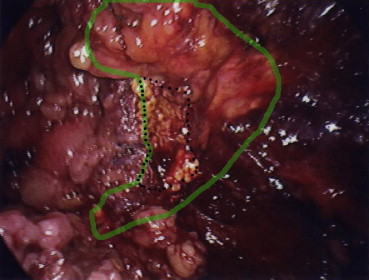 The green line indicates the margin of the adrenal gland and the broken line ...