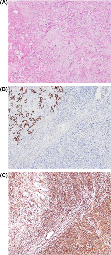 (A) Sarcomatoid carcinoma of the gallbladder. Immunohistochemical staining ...
