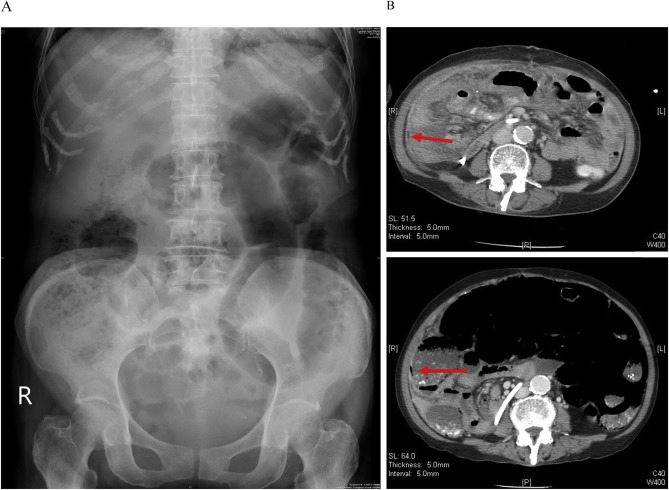 Images of the patient consistent with tuberculous peritonitis. (A) Kidney, ...