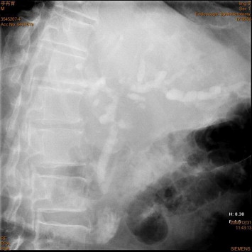 The cholangiography of endoscopic sphincterostomy (December 2008) showed ...