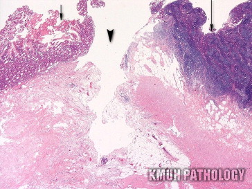 Pathologic photograph (hematoxylin and eosin stain, 20×) reveals the connection ...