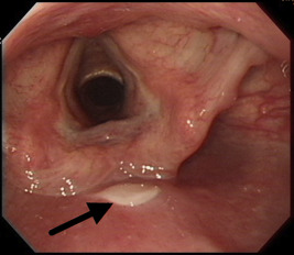 Endoscopic view of the pharynx with a longitudinal membranous lesion at the ...