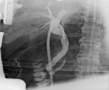 The cholangiography showed normal configuration of the biliary tract. There was ...