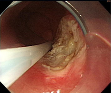 Endoscopic mucosal resection is smooth and leaves an artificial ulcer without ...
