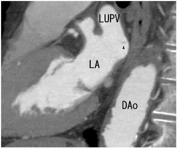 64-MDCT sagittal images showed thrombi in the LA (arrowhead). DAo: descending ...