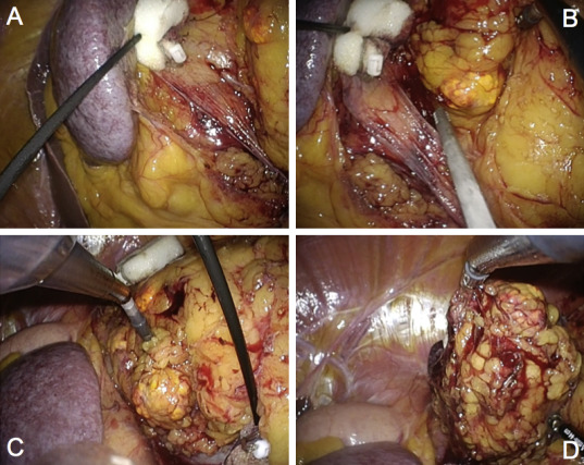 Needle-assisted laparoendoscopic single-site adrenalectomy (left side). (A, B) ...