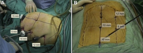 (A) The trocar sites of the total laparoscopic right colectomy procedure; (B) ...