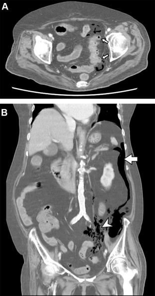 (A) Transverse view of abdominal computed tomography shows multiple outpouching ...