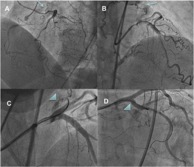 Panel A and B. Bilateral injection showing the atrial collateral channel ...