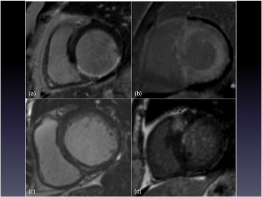 Cardiac magnetic resonance imaging examples of late gadolinium enhancement ...