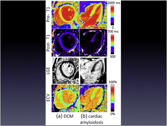 Cardiac magnetic resonance imaging examples of “normal” appearing late ...