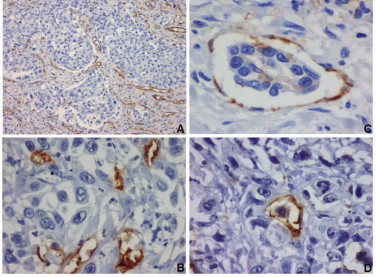 CD31 and D2-40 immunoexpressions in urothelial bladder carcinoma. Intratumoral ...