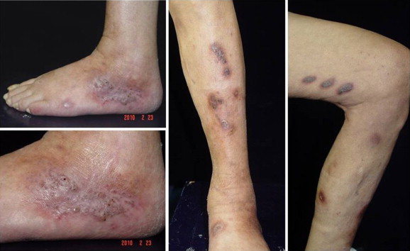 Near resolution of ulcers had occurred after 8 weeks of treatment with ...