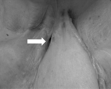 The suitable volume of the deltopectoral flap allowed the tracheocutaneous ...
