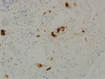 Cytomegalovirus inclusions are observed in capillary endothelial cells and ...