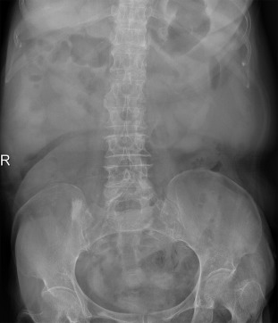 Plain abdominal X-ray shows normal bowel gas pattern.