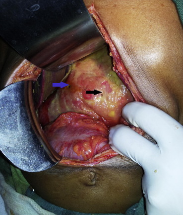 Multiple gastric perforations.