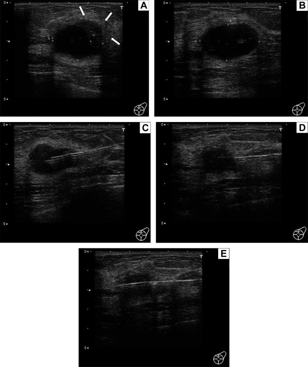 Breast ultrasonography. (A) Part of a solid crescent-shaped tumor mass at the 12 ...