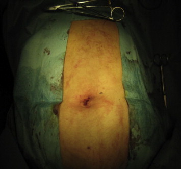 Umbilical wound immediately after surgery.
