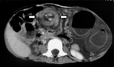 CT demonstrated the “whirl sign” (arrows), with a twisted mesocolon encircling ...