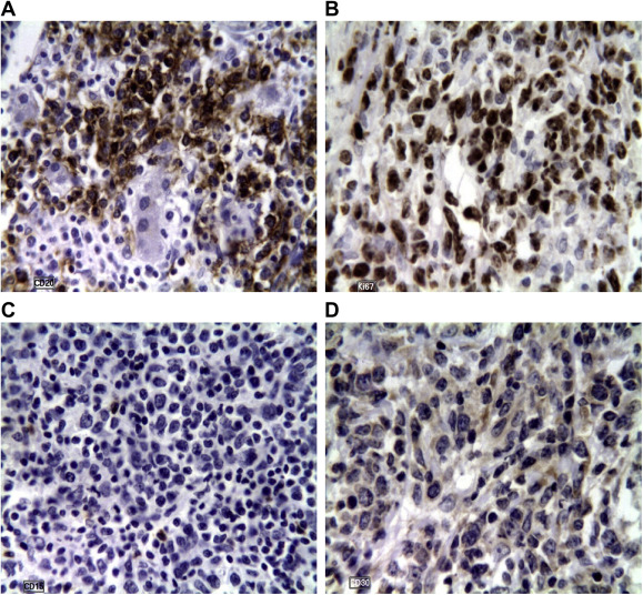 Immunohistochemistry showing (A) positive CD20, a marker of B cell lymphoma; (B) ...