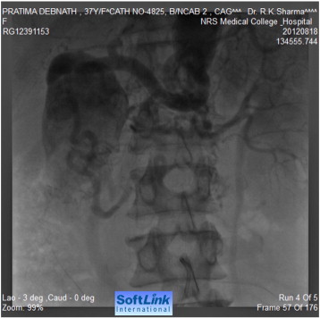 Aortography showing interruption of abdominal aorta below the origin of renal ...
