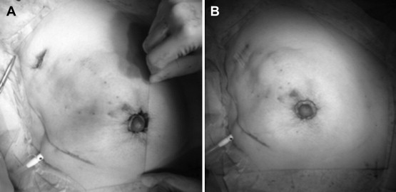 Periareolar incision was approximated in an MRBT case. (A) A purse-string suture ...