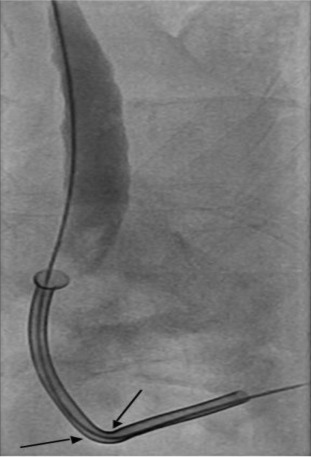 Successful repositioning of Memokath 051 stent across the stricture (arrows).