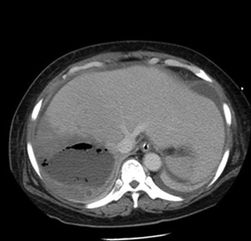 Contrast computed tomography: faintly rim-enhancing gas-forming abscess in the ...