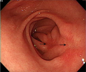Esophagogastroduodenoscopy at follow-up shows two linear ulcer scars (arrows) ...