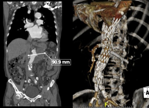 Late intervention, Patient 3.