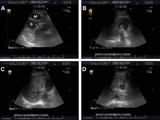 Abdominal ultrasound. (A) One irregular hypoechoic mass lesion (M) ...